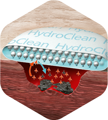 Illustration showing the release of Ringer’s solution of HydroClean® plus