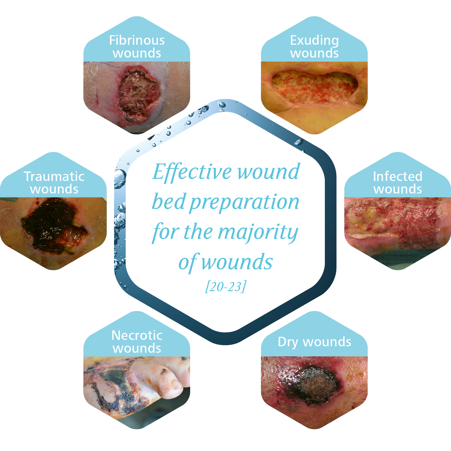 HydroClean® plus can be used for effective wound bed preparation for the majority of wounds.