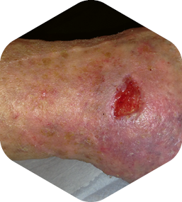 Case images demonstrating the healing process using HydroTherapy®: After 6 weeks transition to HydroTac®