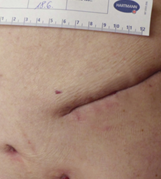 Wound post operative healing