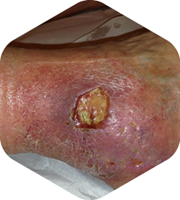 Case images demonstrating the healing process using HydroTherapy®: Start with HydroClean® plus