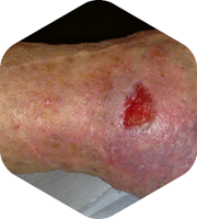 Case images demonstrating the healing process using HydroTherapy®: After 6 weeks transition to HydroTac®
