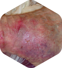 Case images demonstrating the healing process using HydroTherapy®: After 13 weeks full wound closure